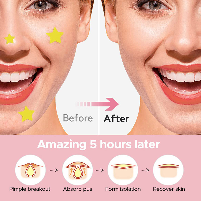600 PCS/Set Star Pimple Patch  - Beauty Makeup Tools ulasan dan harga